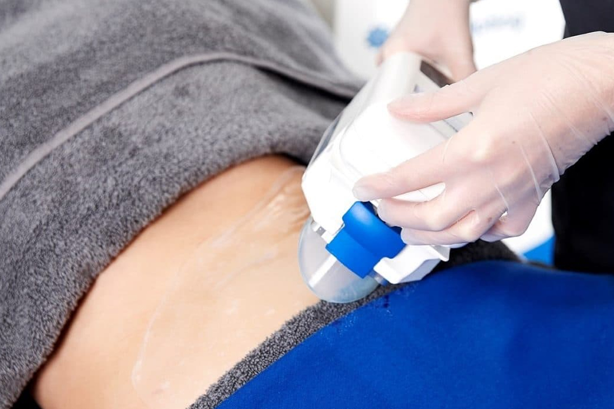 8 questions we have about CoolSculpting® answered